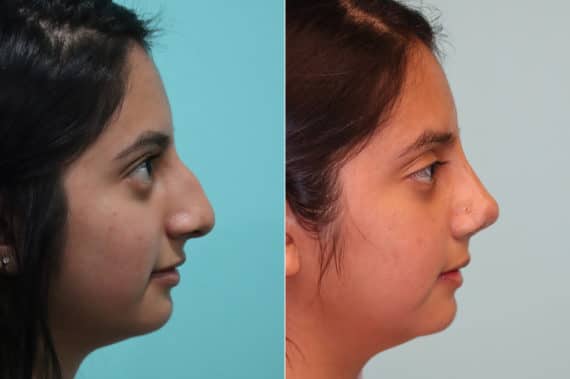 Before and after Rhinoplasty by Dr. Shervin Naderi, Patient 20174