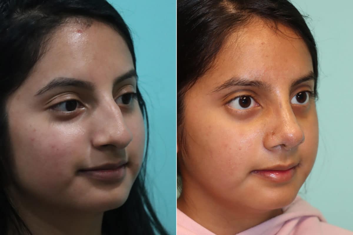 Before and after Rhinoplasty by Dr. Shervin Naderi, Patient 20174