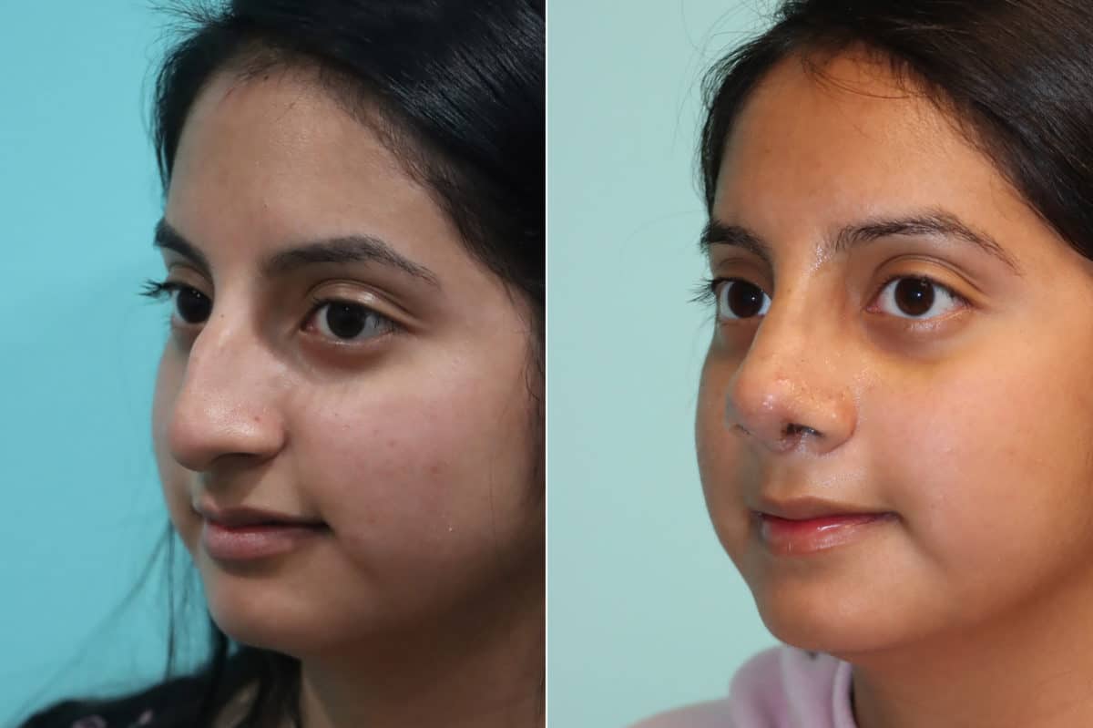 Before and after Rhinoplasty by Dr. Shervin Naderi, Patient 20174