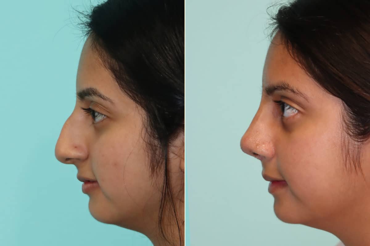 Before and after Rhinoplasty by Dr. Shervin Naderi, Patient 20174