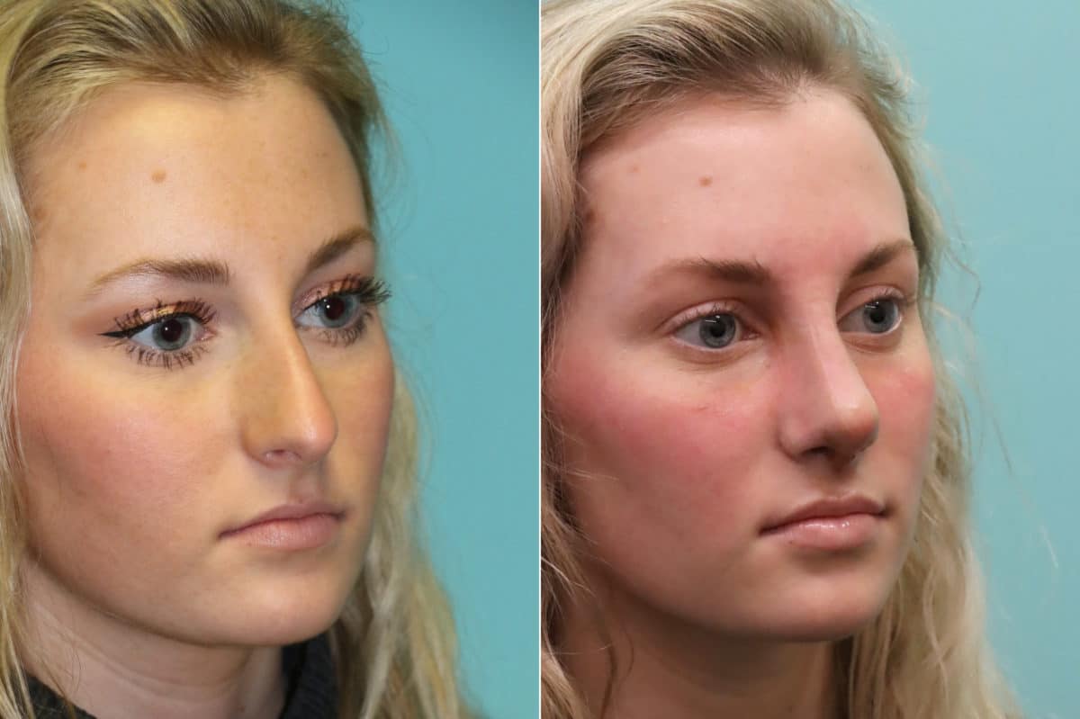 Before and after Rhinoplasty by Dr. Shervin Naderi, Patient 20176