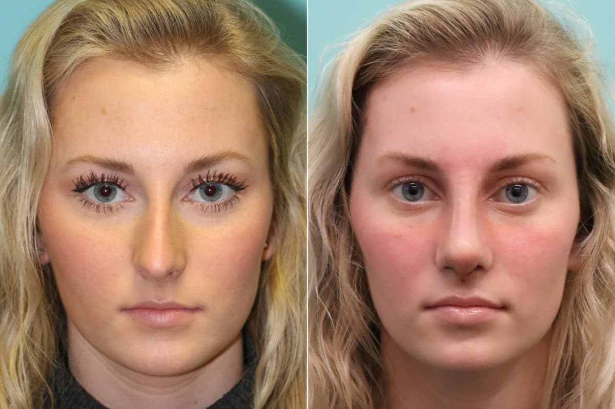 Before and after Rhinoplasty by Dr. Shervin Naderi, Patient 20176