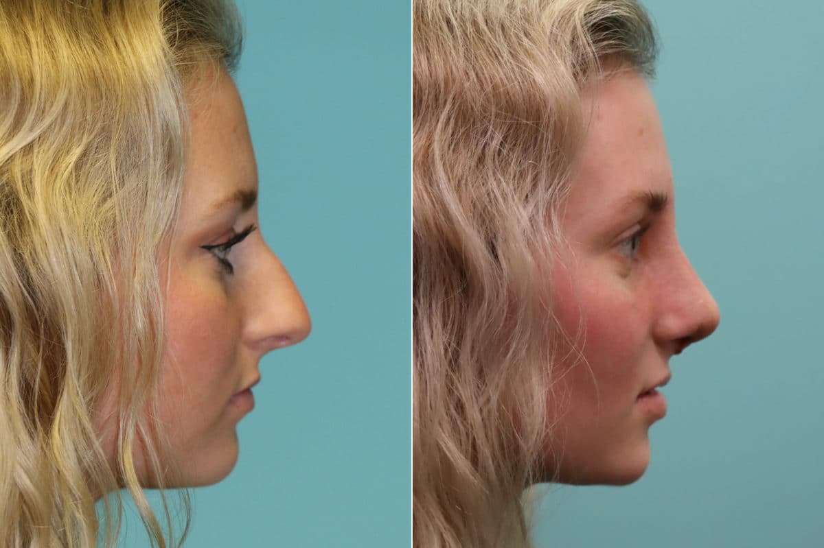 Before and after Rhinoplasty by Dr. Shervin Naderi, Patient 20176