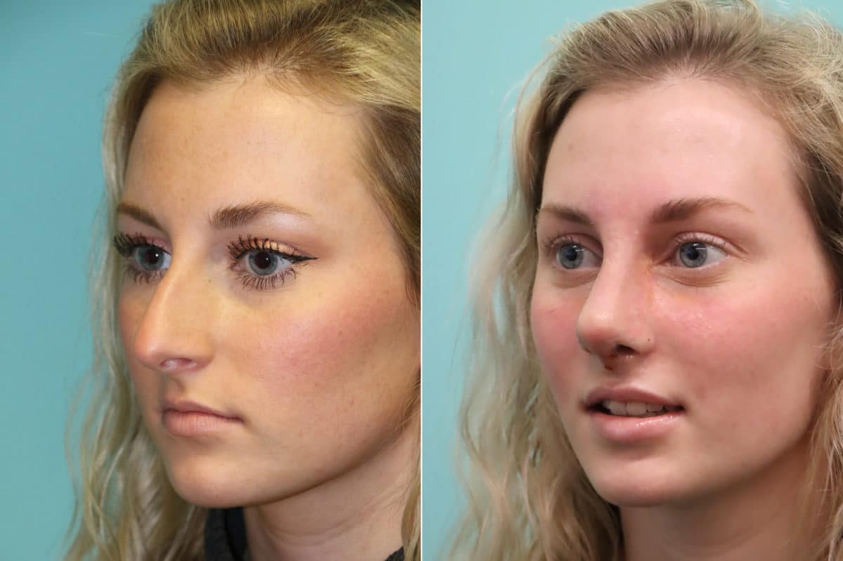 Before and after Rhinoplasty by Dr. Shervin Naderi, Patient 20176