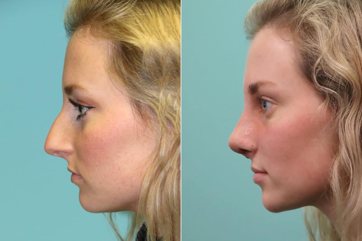 Before and after Rhinoplasty by Dr. Shervin Naderi, Patient 20176