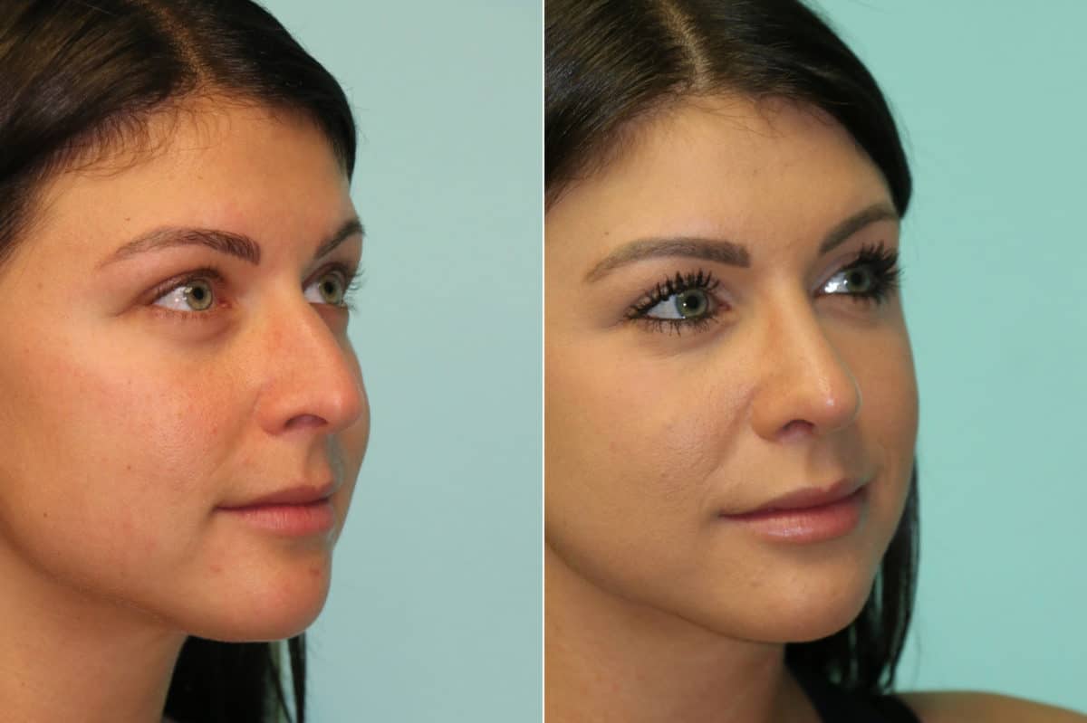 Before and after Rhinoplasty by Dr. Shervin Naderi, Patient 20218