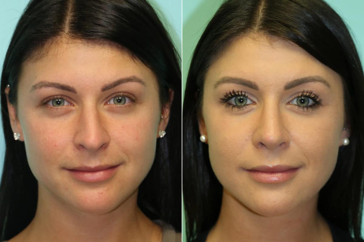 Before and after Rhinoplasty by Dr. Shervin Naderi, Patient 20218