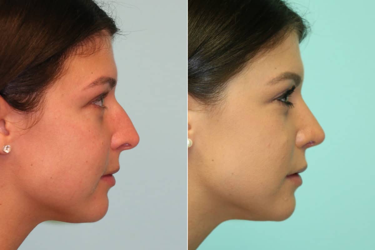 Before and after Rhinoplasty by Dr. Shervin Naderi, Patient 20218