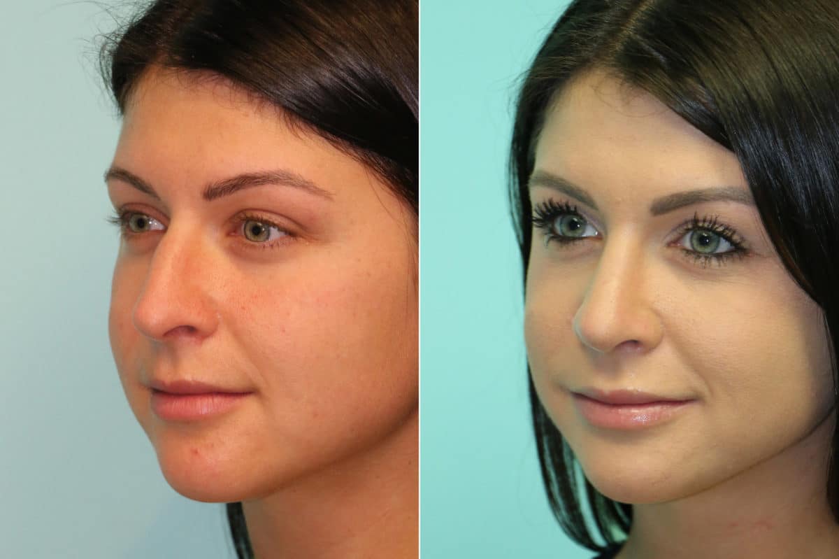 Before and after Rhinoplasty by Dr. Shervin Naderi, Patient 20218