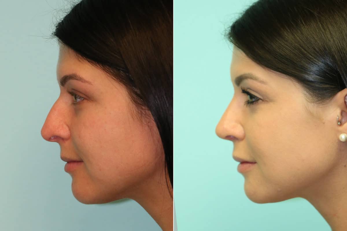 Before and after Rhinoplasty by Dr. Shervin Naderi, Patient 20218