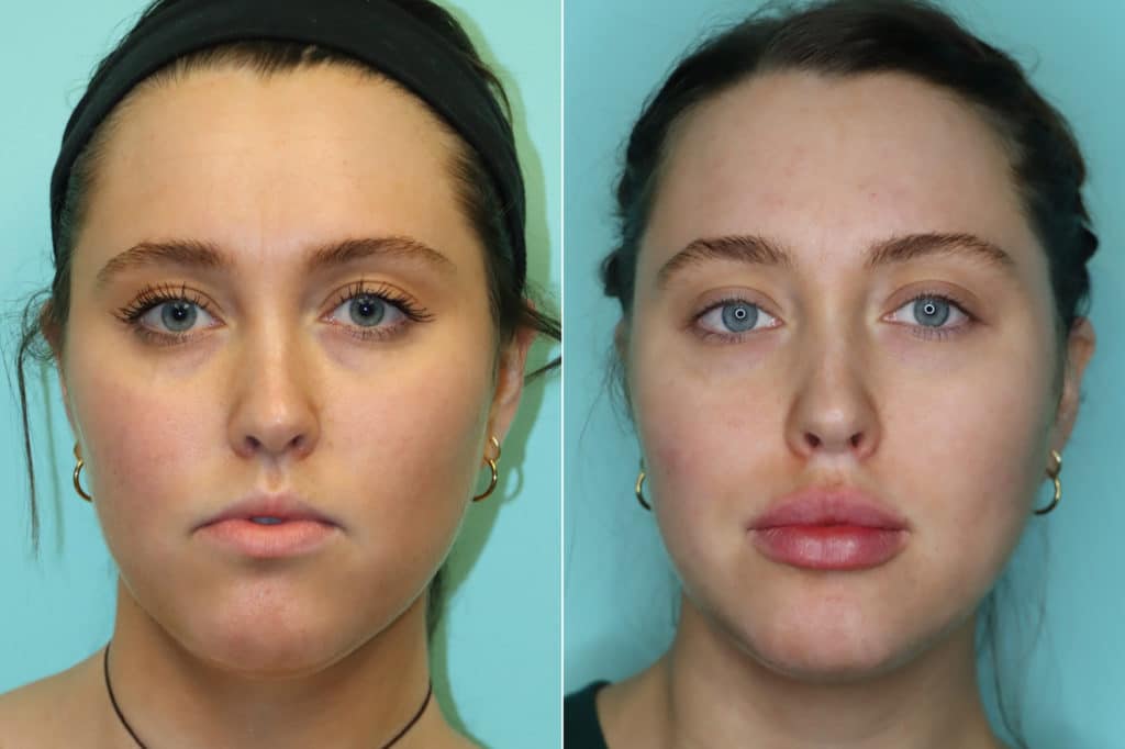 Lip Augmentation photos | Chevy Chase, MD | Patient 20259