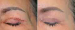 Before and after Scar Revision by Dr. Shervin Naderi, Patient 20263