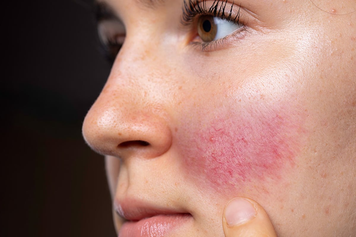 Retinol and rosacea discount