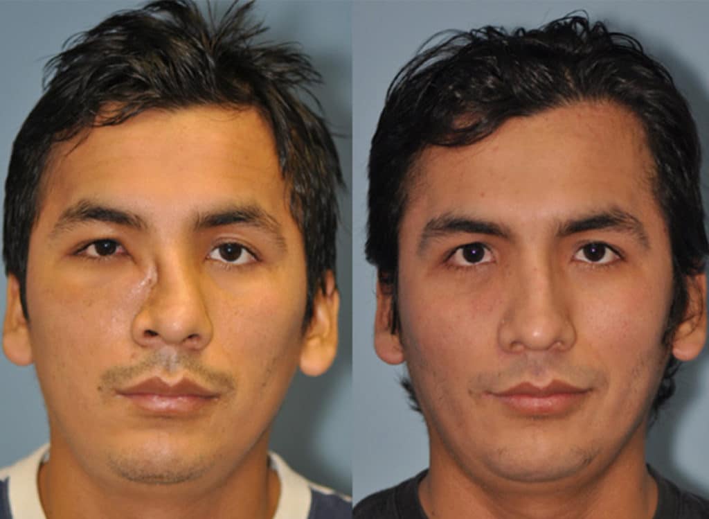 Before and after patient photo of Septoplasty