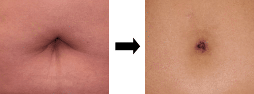 Tummy Tuck Scars: What to Expect, Berman Cosmetic Surgery