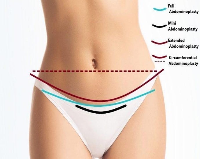 Abdominoplasty incision, techniques and scar lines. The Naderi Center | Virginia | Maryland  
