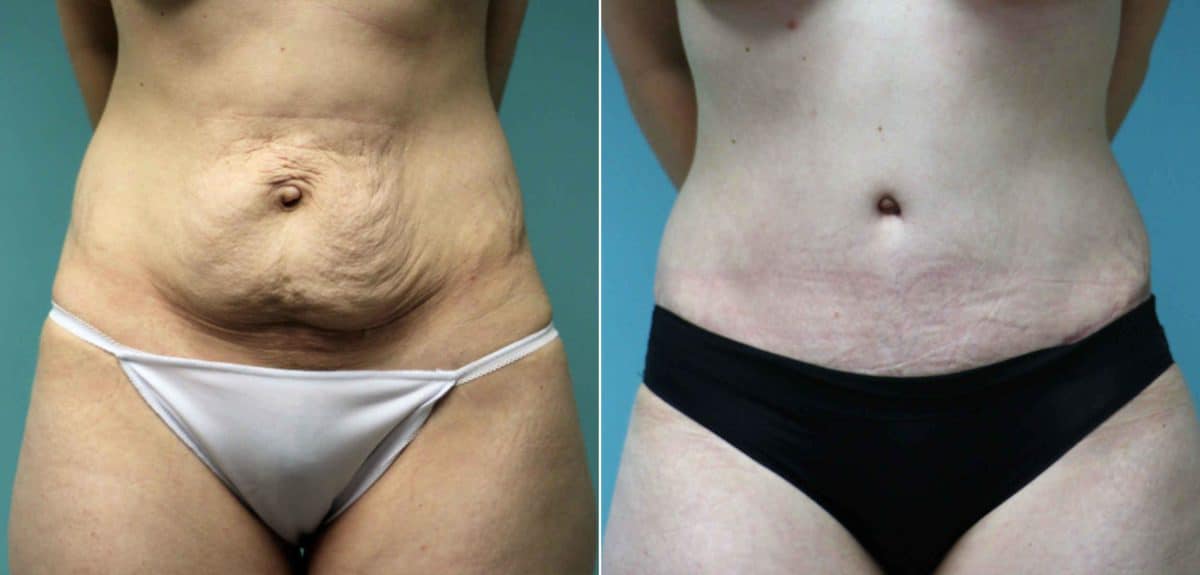 4 Tips for a Smooth Tummy Tuck Recovery