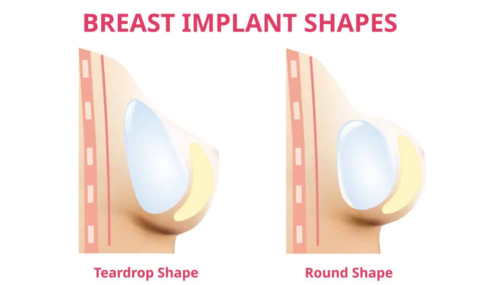 Different Types of Breast Implants