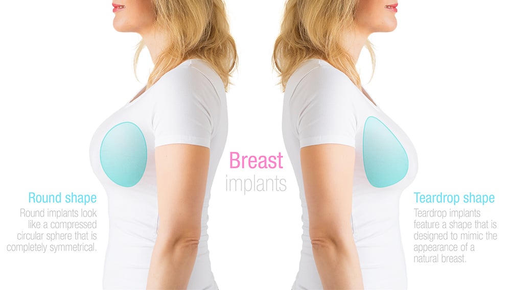 Breast Reconstruction, Natrelle® Gummy Implants