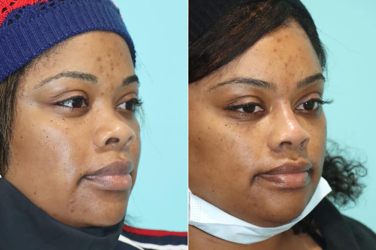 Before and after Non-Surgical Rhinoplasty by Dr. Shervin Naderi, Patient 21139