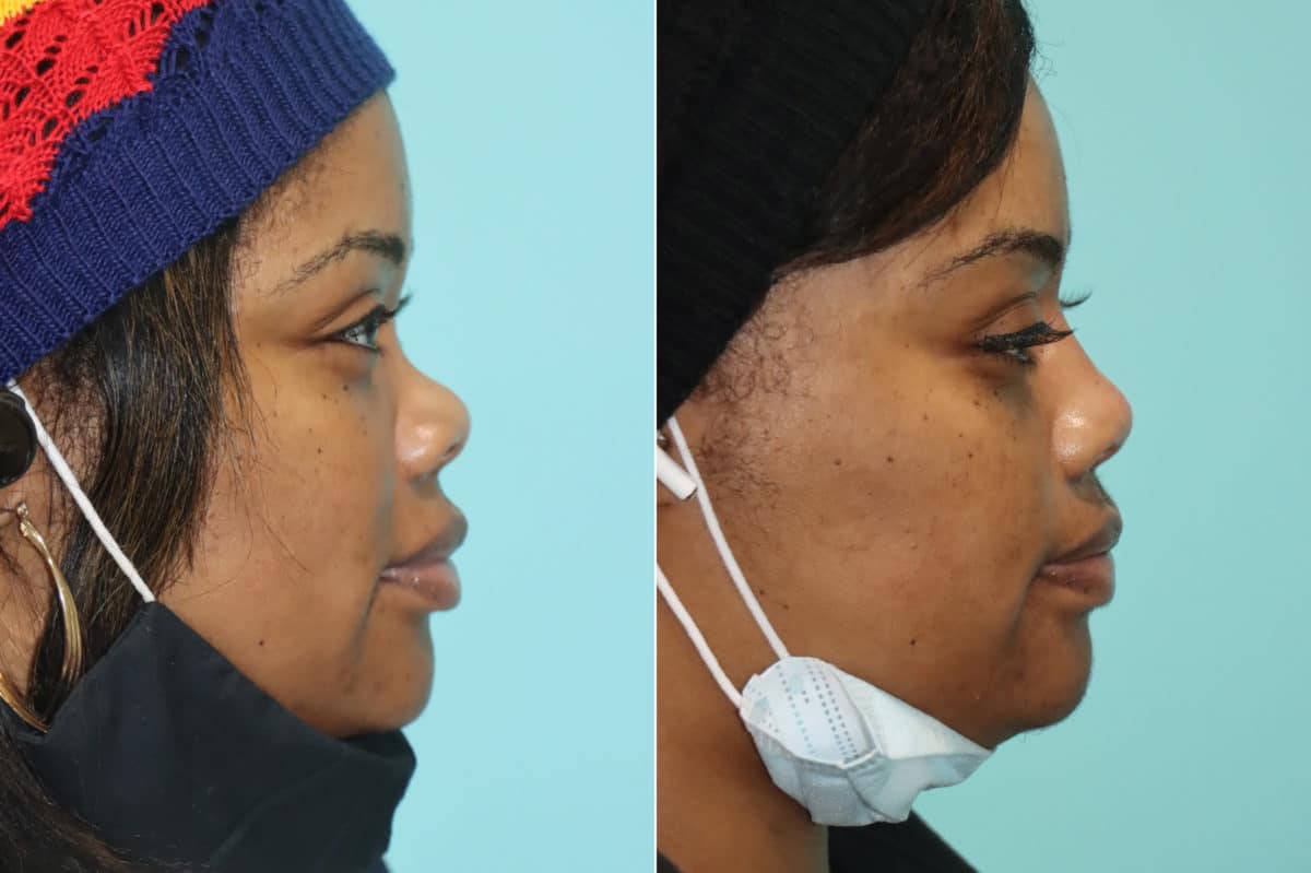 Before and after Non-Surgical Rhinoplasty by Dr. Shervin Naderi, Patient 21139