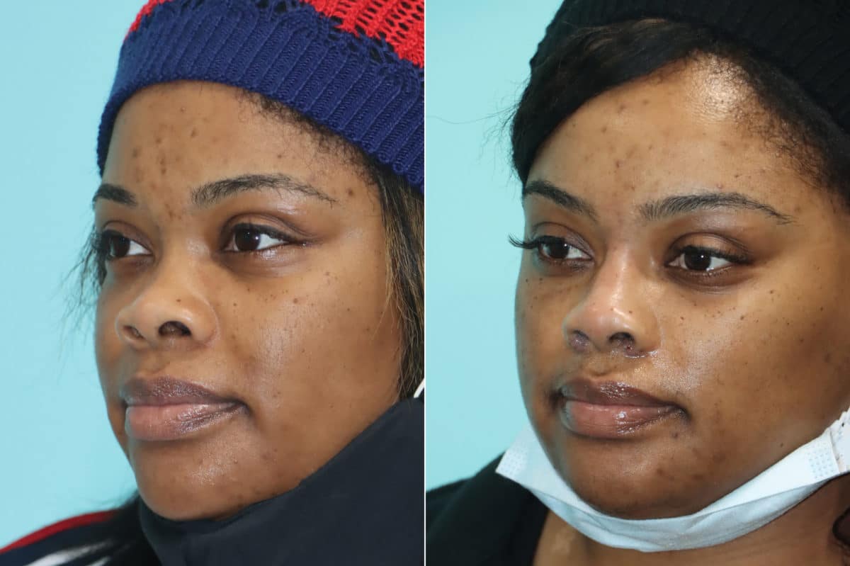 Before and after Non-Surgical Rhinoplasty by Dr. Shervin Naderi, Patient 21139