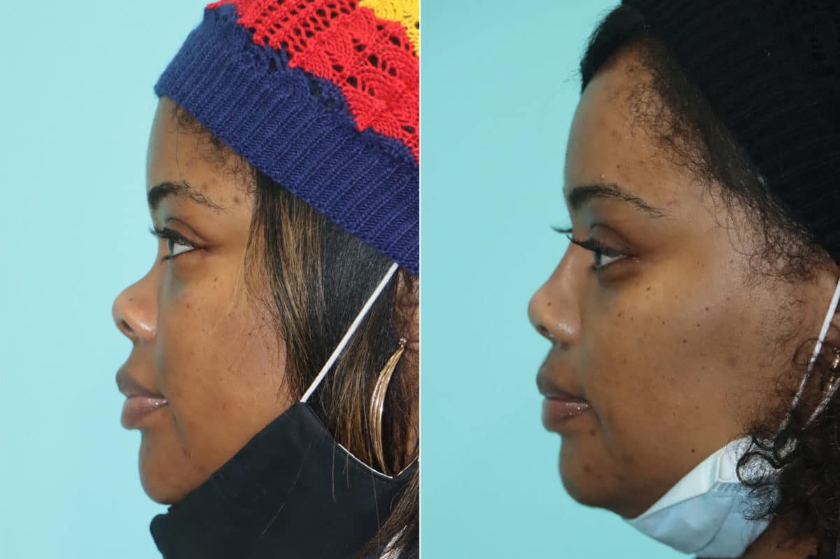 Before and after Non-Surgical Rhinoplasty by Dr. Shervin Naderi, Patient 21139