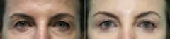 Before and after Blepharoplasty by Dr. Shervin Naderi, Patient 21268