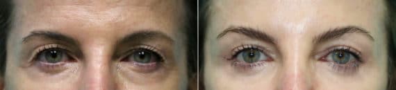 Before and after Blepharoplasty by Dr. Shervin Naderi, Patient 21268