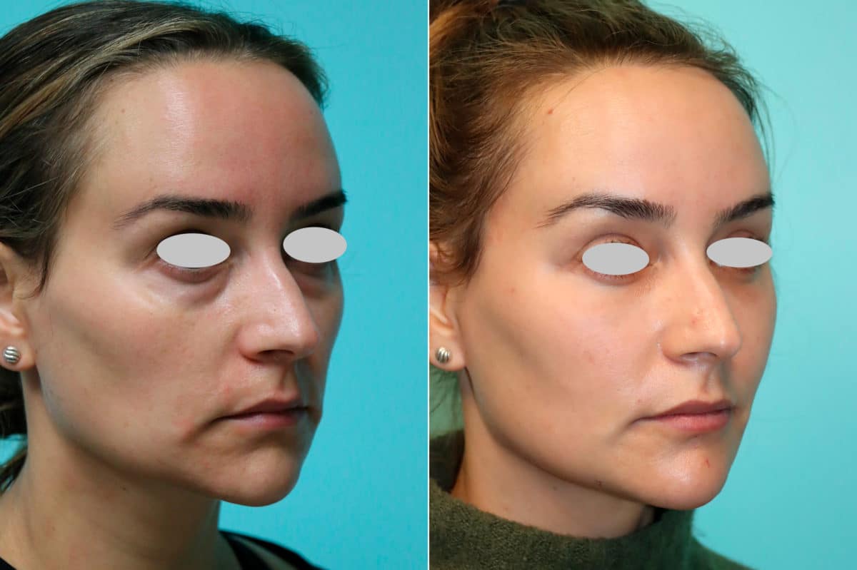 Before and after Blepharoplasty by Dr. Shervin Naderi, Patient 21310