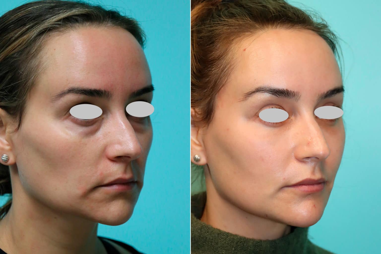 Tear Trough / Under Eye Injections before and after photos The Naderi