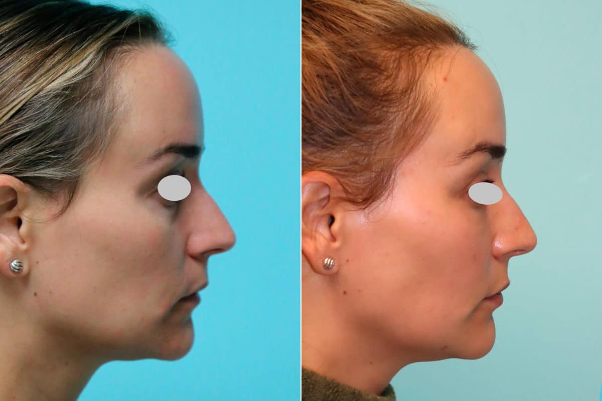 Before and after Blepharoplasty by Dr. Shervin Naderi, Patient 21310