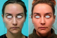 Before and after Blepharoplasty by Dr. Shervin Naderi, Patient 21310