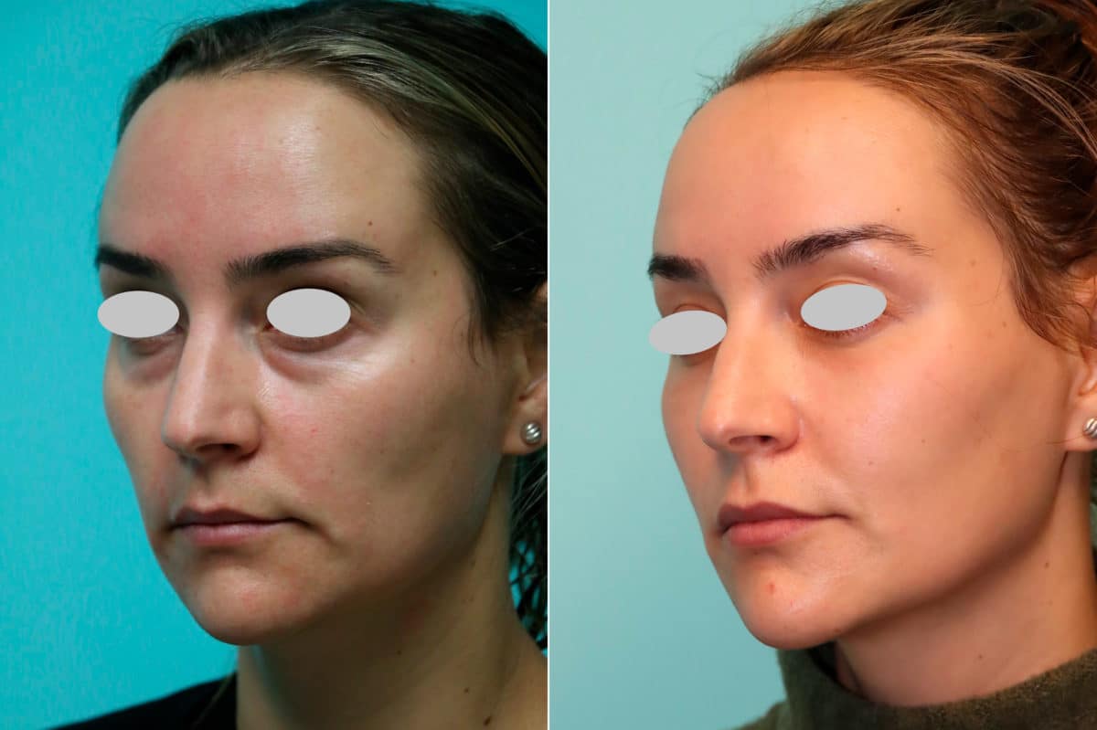 Before and after Blepharoplasty by Dr. Shervin Naderi, Patient 21310