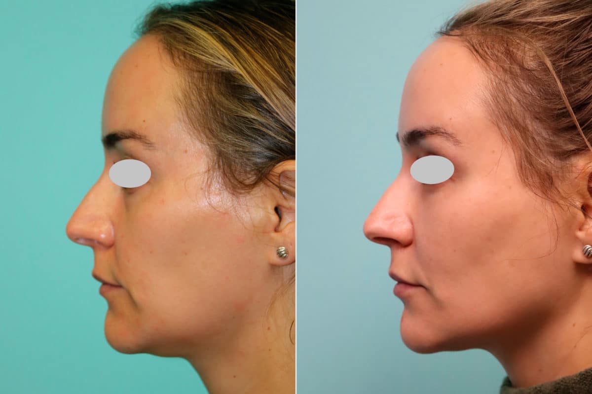 Before and after Blepharoplasty by Dr. Shervin Naderi, Patient 21310