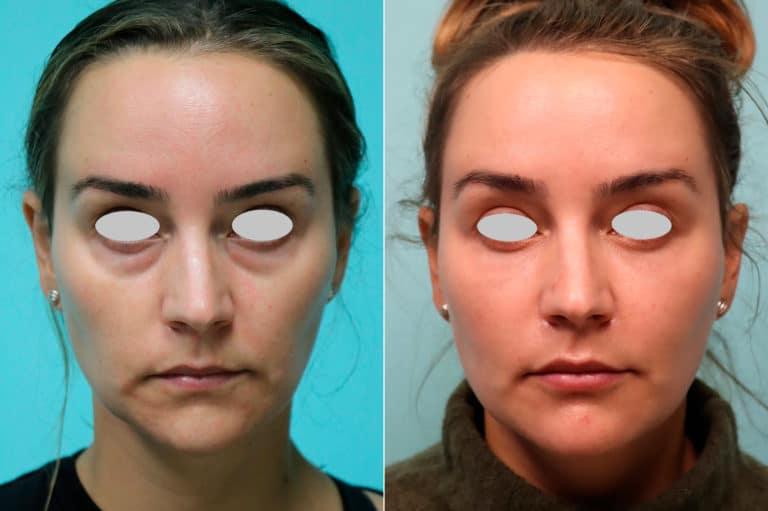 Tear Trough Under Eye Injections Before And After Photos Plastic