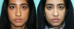 Before and after Cheeks / Midface Injections by Dr. Shervin Naderi, Patient 21311