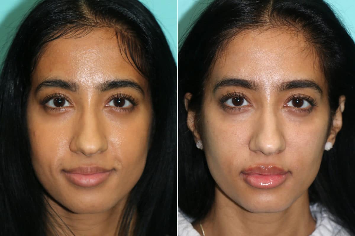 Before and after Cheeks / Midface Injections by Dr. Shervin Naderi, Patient 21311