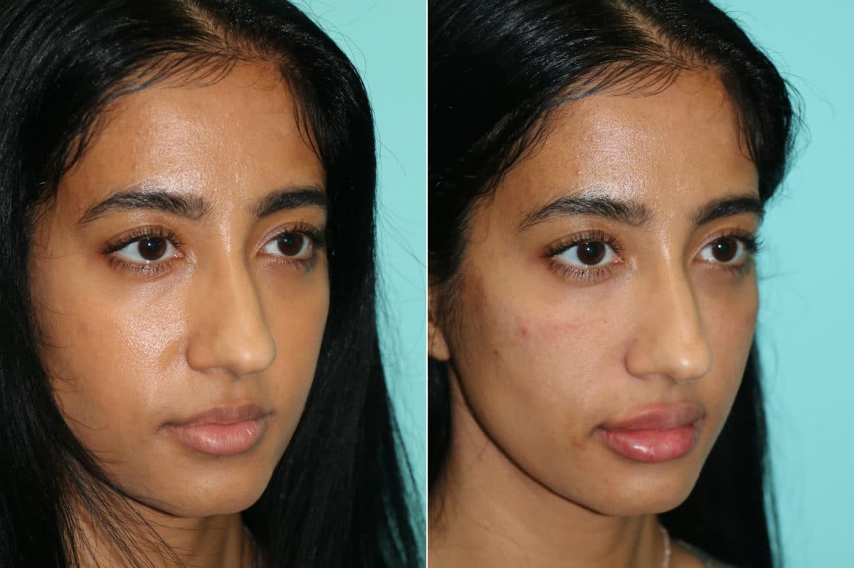 Before and after Cheeks / Midface Injections by Dr. Shervin Naderi, Patient 21311