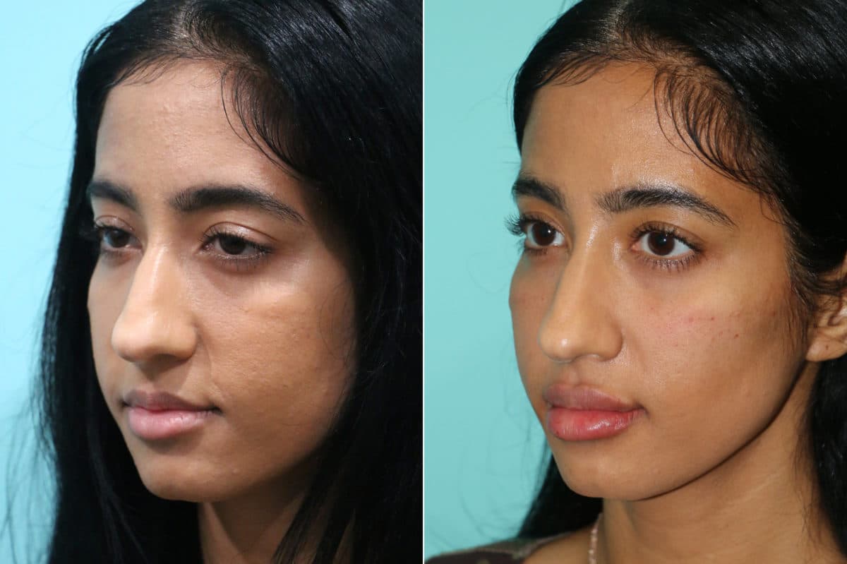 Before and after Cheeks / Midface Injections by Dr. Shervin Naderi, Patient 21311