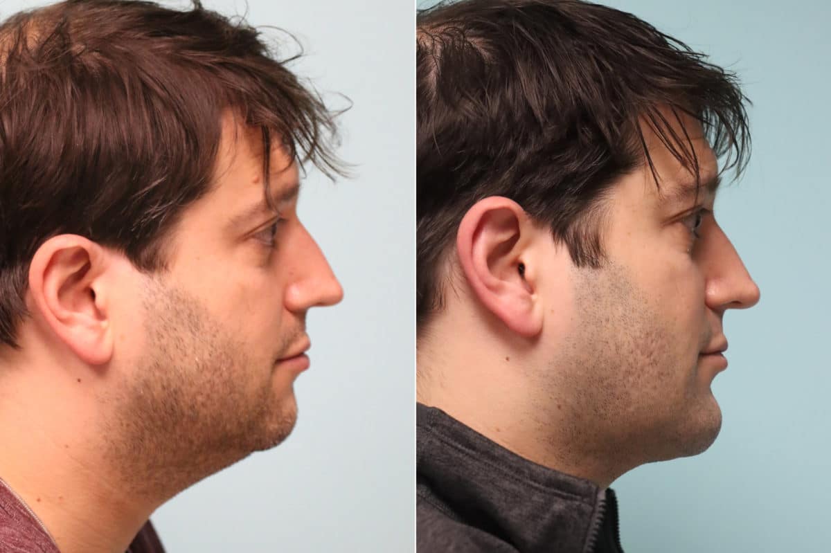 Before and after Chin & Facial Implant by Dr. Shervin Naderi, Patient 21382