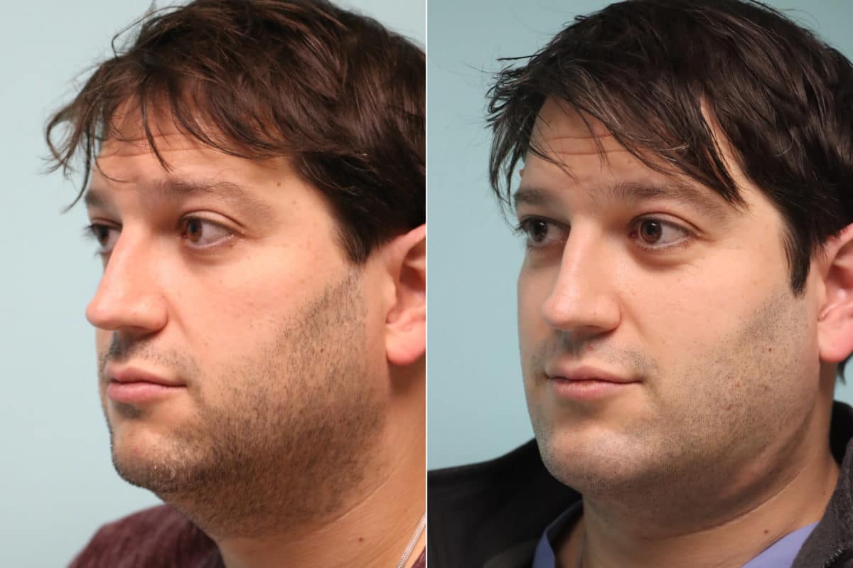 Before and after Chin & Facial Implant by Dr. Shervin Naderi, Patient 21382