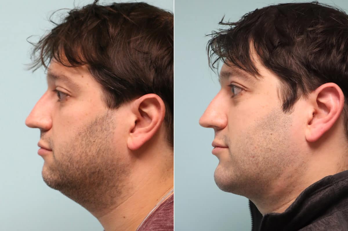 Before and after Chin & Facial Implant by Dr. Shervin Naderi, Patient 21382