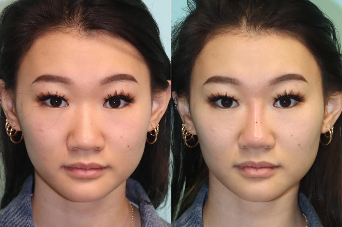 Before and after Non-Surgical Rhinoplasty by Dr. Shervin Naderi, Patient 21448