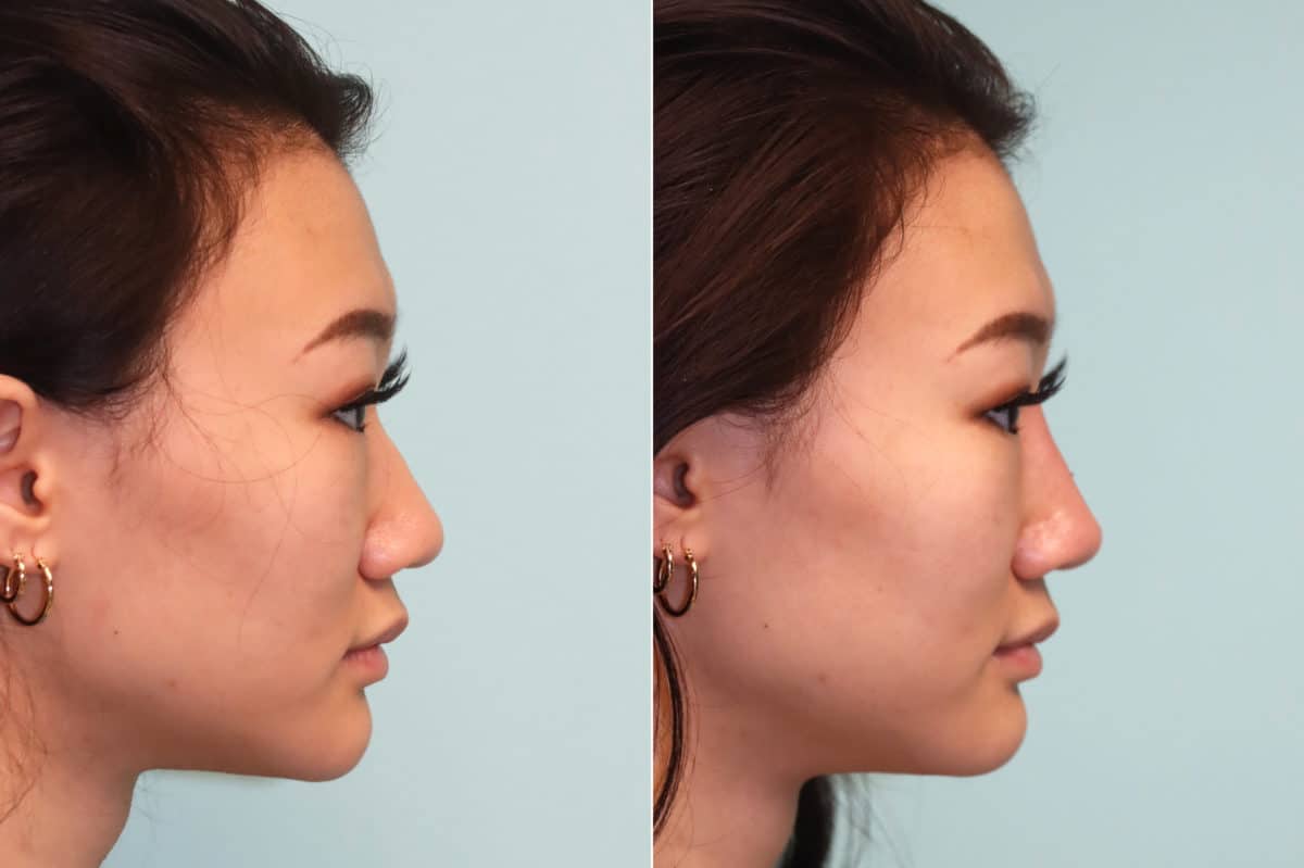 Before and after Non-Surgical Rhinoplasty by Dr. Shervin Naderi, Patient 21448