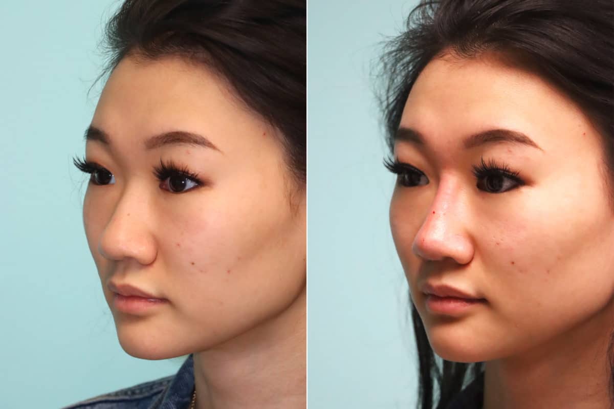 Before and after Non-Surgical Rhinoplasty by Dr. Shervin Naderi, Patient 21448