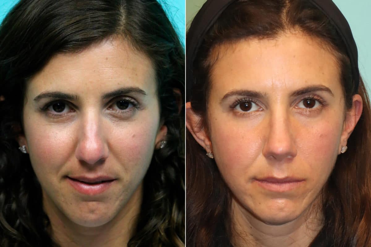 Before and after Rhinoplasty by Dr. Shervin Naderi, Patient 21551