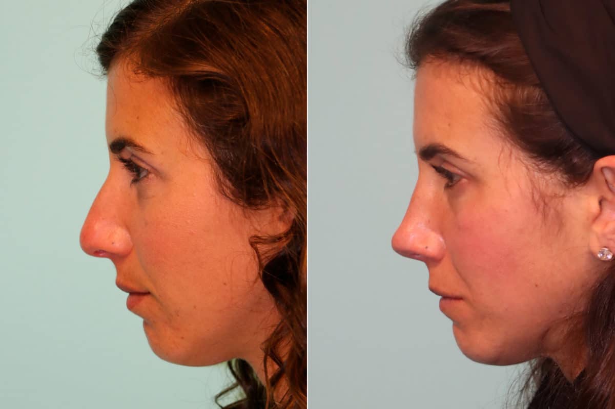 Before and after Rhinoplasty by Dr. Shervin Naderi, Patient 21551