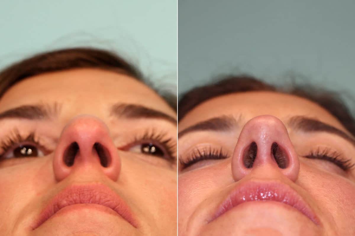 Before and after Rhinoplasty by Dr. Shervin Naderi, Patient 21551