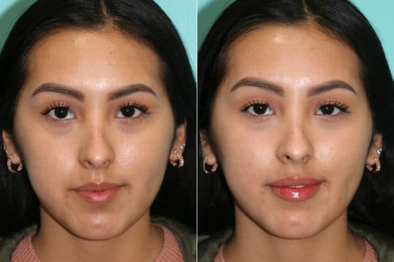 Before and after Lip Augmentation by Dr. Shervin Naderi, Patient 21600